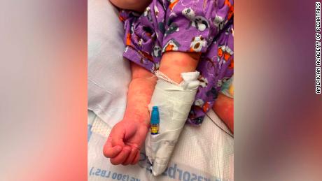 Kids with suspected Covid-related syndrome need immediate attention