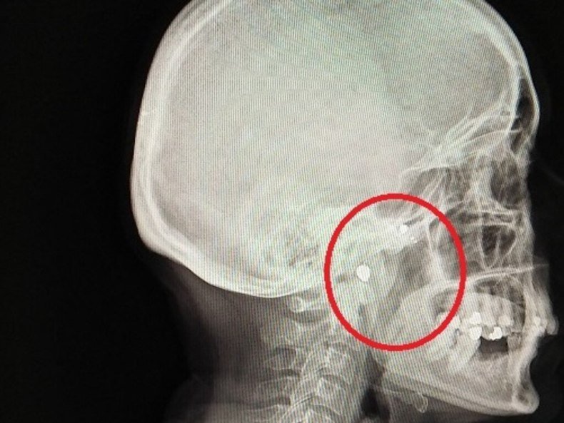 Basia Hellwich was shot three times by William Kelvin Fox in 1992. An x-ray shows a bullet still in her head. She also has bullet fragments in her body. Basia Hellwich was shot three times by William Kelvin Fox in 1992. An x-ray shows a bullet still in her head. She also has bullet fragments in her body.